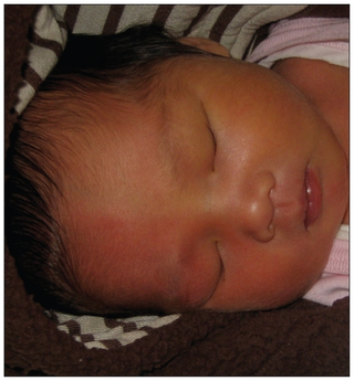Illustration for article titled This is Why Some Newborn Babies Turn Half-Red